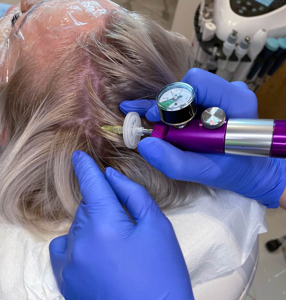 Karboksyterapia skóry głowy na porost włosów Białystok