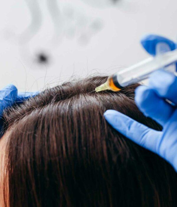 Osocze bogatopłytkowe na porost włosów